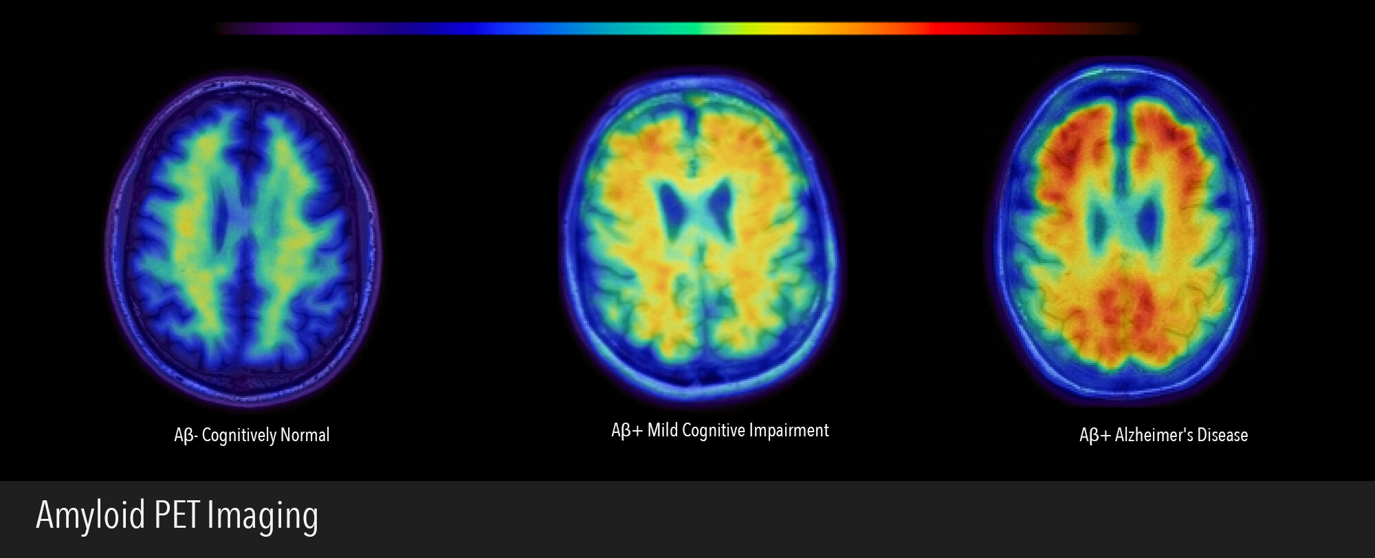 amyloid pet imaging